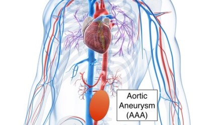 Aneurisma de la Aorta Abdominal (AAA)