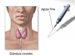 Biopsia de la gl‡ndula tiroides