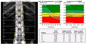 DXA_Lumbar_vertebral_column_Osteopenia_es