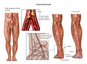 ADTRJ6 Progression of Arterial Blockage in the Right Leg