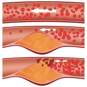 Cholesterol plaque in artery (atherosclerosis) illustration. Top artery is healthy. Middle & bottom arteries show plaque formation, rupturing, clotting & blood flow occlusion.