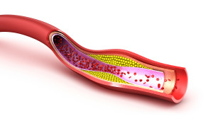 Cholesterol plaque in blood vessel