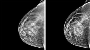 mamografia3d_1
