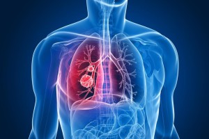 Lung-cancer-survival-increases-sharply-if-caught-early-study-says