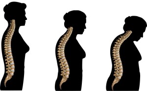 osteoporosis-is-caused-by-opti-25281002-1