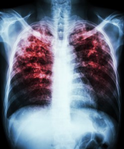 X-Ray of chest with tuberculosis.