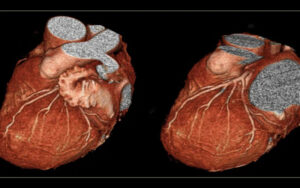 Angiotomografía Coronaria